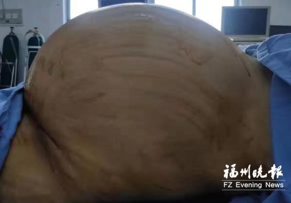 肥胖瘤(肥胖瘤会长舌头吗)