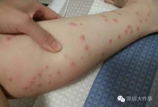 虫子咬了后红肿并且还蔓延，被虫子咬了红肿很痒蔓延（小伙被虫子咬一口手臂一路红肿）