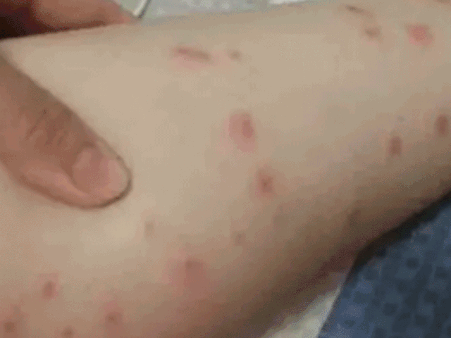 虫子咬了后红肿并且还蔓延，被虫子咬了红肿很痒蔓延（小伙被虫子咬一口手臂一路红肿）