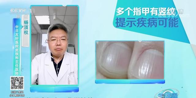 糖尿病竖纹(糖尿病指纹浅)