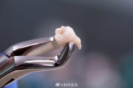 糖尿病拔牙止血(糖尿病拔牙出血)