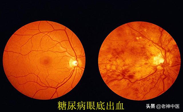 糖尿病眼底出血偏方(糖尿病眼底出血多久失明)
