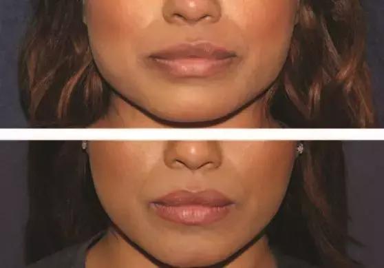 立马见效脸变小的方法，四招让你快速瘦脸