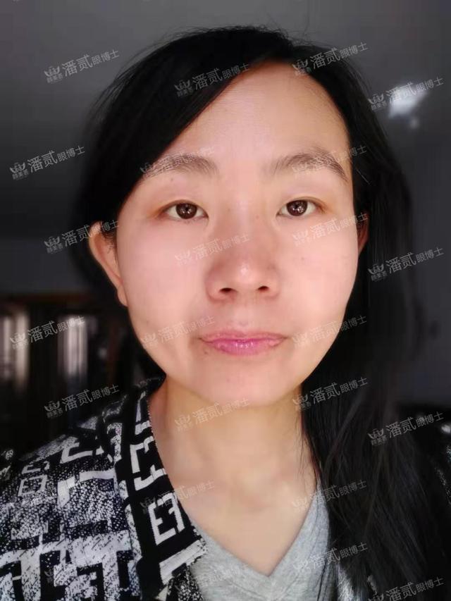 肥胖上睑下垂(上睑下垂会加重吗)