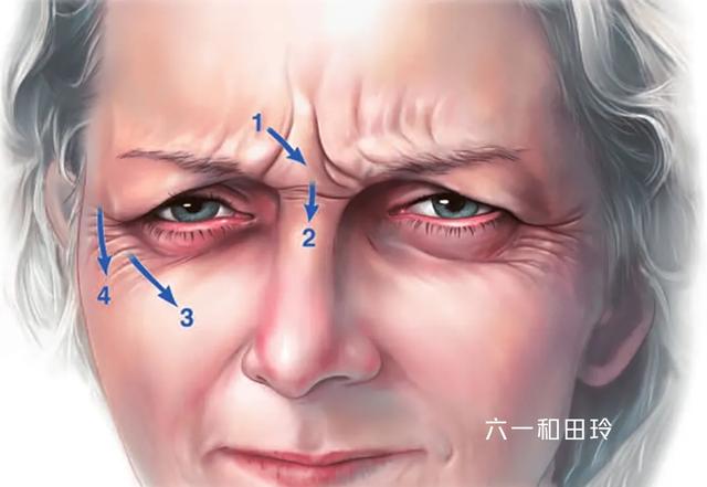 额头有皱纹怎么办，额头有皱纹眼睛下面也有皱纹