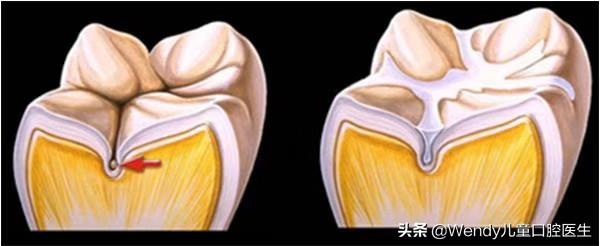 一张刷爆朋友圈的牙片，成年人要做牙齿窝沟封闭