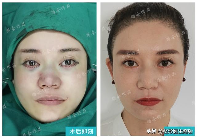 膨体填充泪沟失败案例，小助理欢欢同你聊一聊