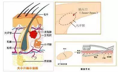 治疗腋臭较专业的医生是(治疗腋臭较专业的医生)