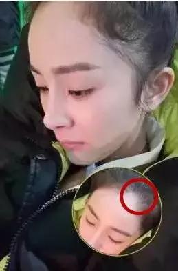 如何降低发际线，如何自然降低发际线（让你改头换面）