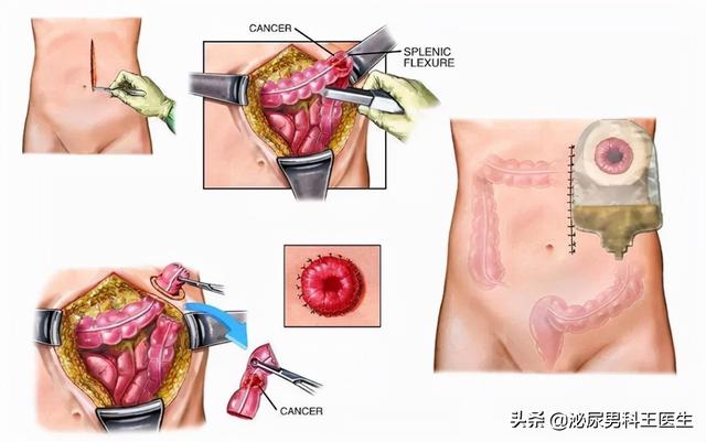 什么情况下要人造肛门，我国“造口人”超百万
