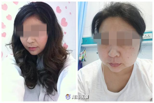 肥胖满月脸(满月脸会消吗)