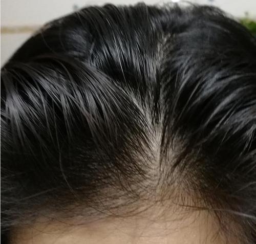 头皮螨虫是什么原因造成的，头上出现这3个迹象