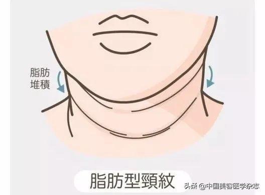 脖子肥胖颈纹(脖子有颈纹怎么办跟胖瘦有关系吗)