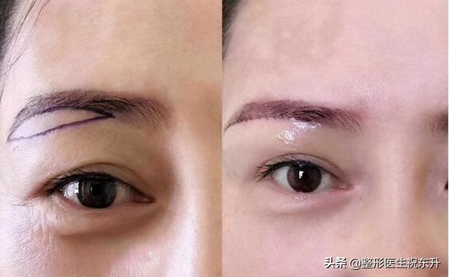 糖尿病能纹眉嘛(糖尿病病人能纹眉吗)