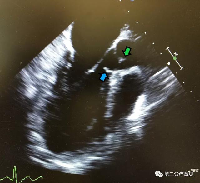 肥胖心脏杂音(肥胖心脏大的原因分析)