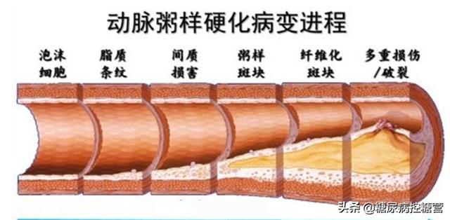 糖尿病共识铬(糖尿病指南视频)