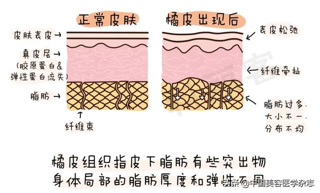 橘皮组织型肥胖(橘皮组织型肥胖怎么减肥)
