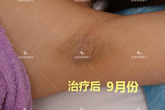 遗传的腋臭看什么科室医生(遗传性腋臭怎么治疗断根)