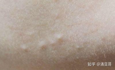 闭口和痘痘的区别，长痘痘和闭口的区别（其实并不相同....）