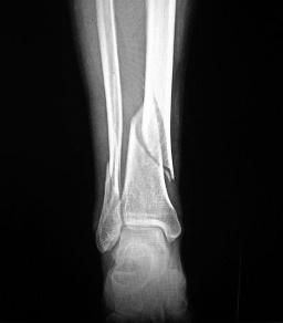 跟骨骨折怎么做牵引，为什么骨折了要做骨牵引