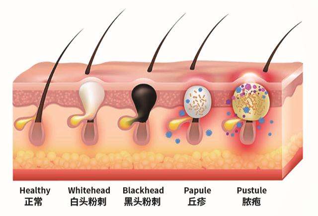 结节性痤疮图片，痤疮的不同形态（痤疮是怎么引起的）