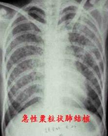 正常肺部x光片，常见肺部疾病的胸片特点（肺部疾病的影像基本征象）