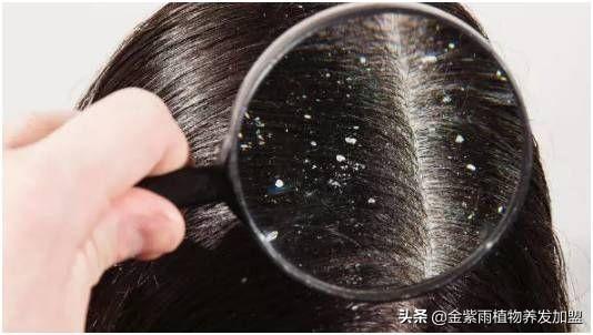 最简单快速去除头皮屑，简单快速去除头屑的小妙招（清理头屑的四个小妙招）