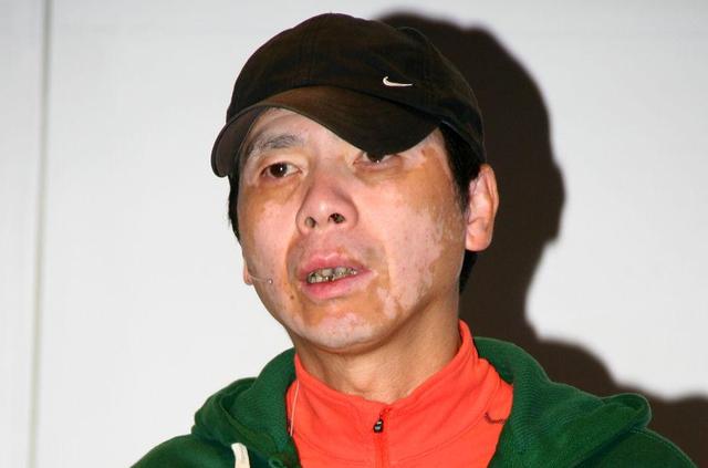 冯小刚得了什么病，冯小刚因何得了白癜风（移民风波后的冯小刚现身）
