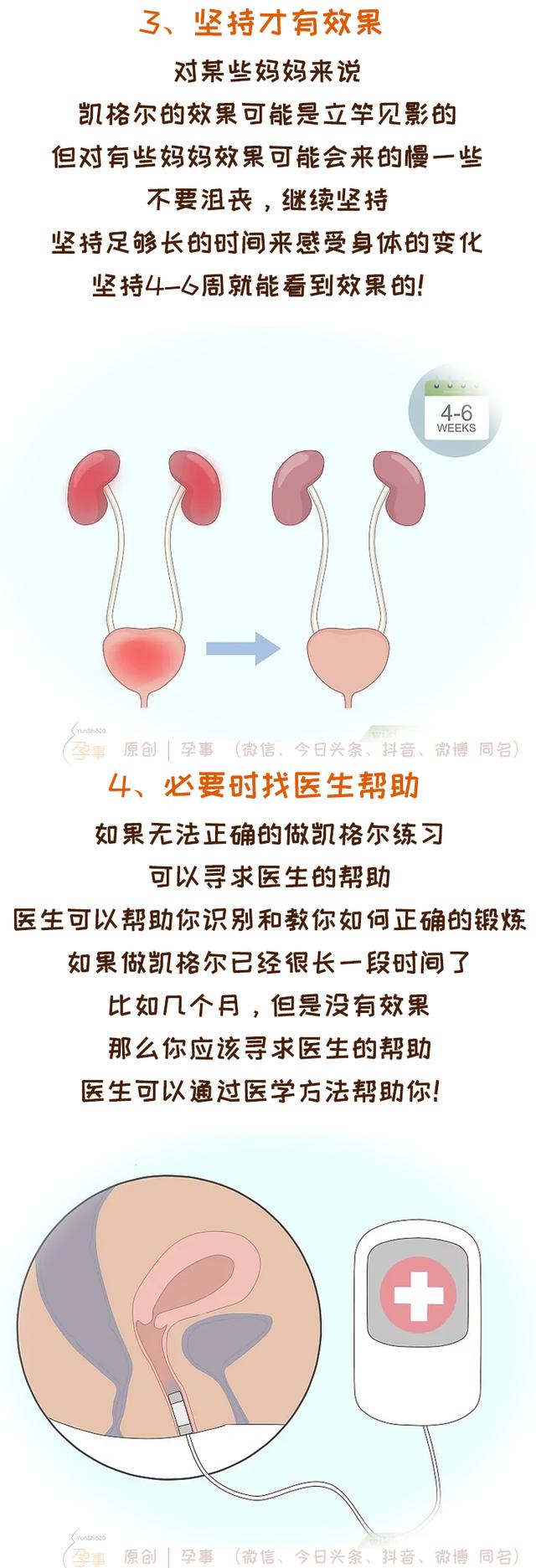 凯格尔运动方法，凯格尔运动，你做对了吗