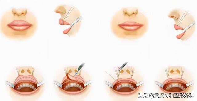 常见的唇部整形都有哪些，唇部整形有什么方法