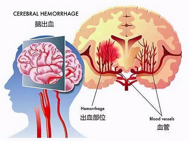 高血压引起的脑出血急救方法，高血压引起的出血性脑中