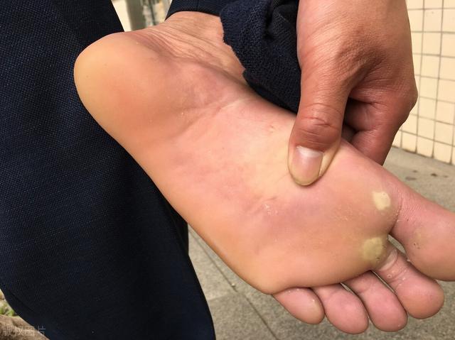 跖疣是什么东西，脚底跖疣是什么