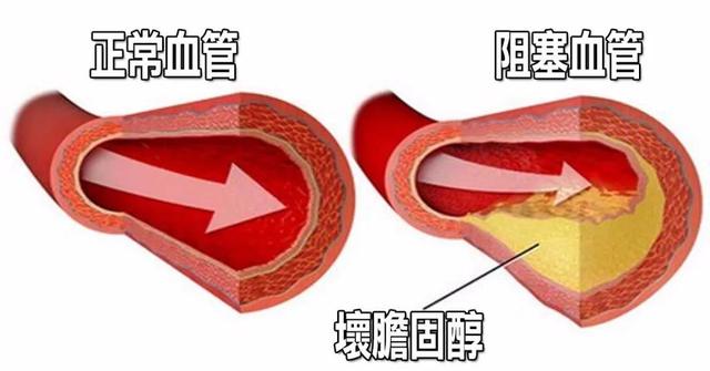 糖尿病合并高脂血症(糖尿病合并高脂血症血脂控制范围)