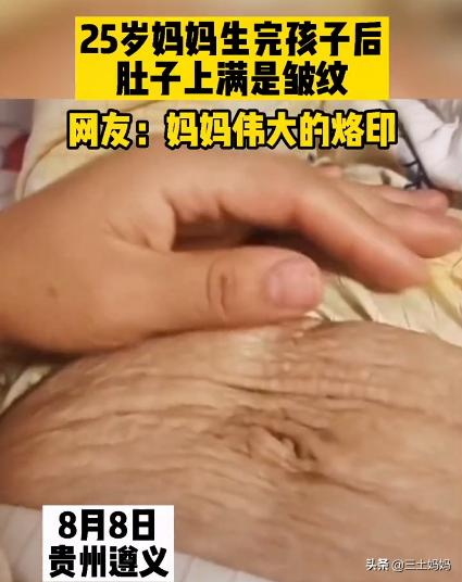 产后肥胖纹白色(产后白色妊娠纹怎么办)