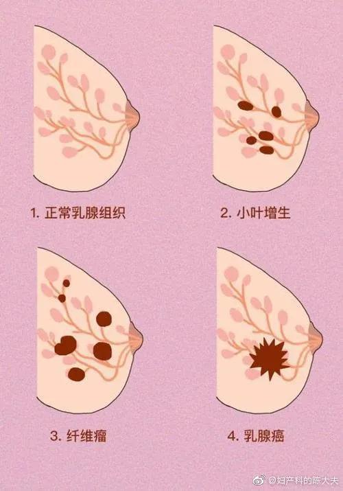 乳腺增生与肥胖有关吗(肥胖乳腺增生会自己消失吗)