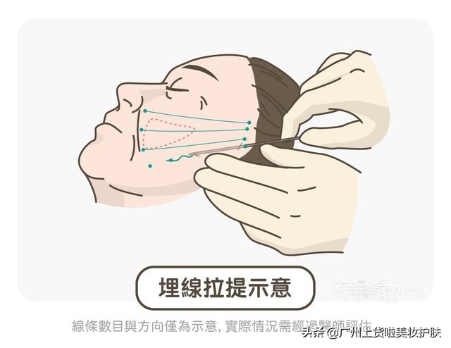 真正能改善法令纹的办法，法令纹显老10岁