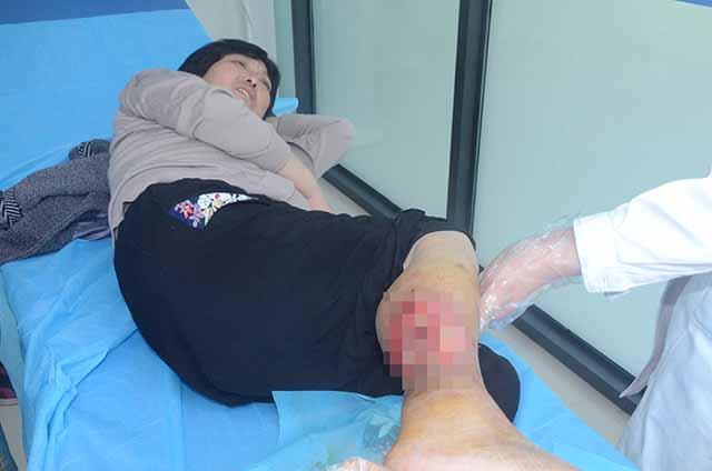 糖尿病足结咖(糖尿病足干性结痂)