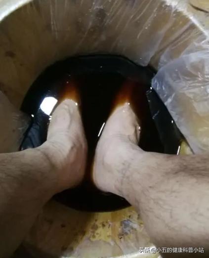 治疗足癣最快最好的办法是什么，用醋泡脚能摆脱足癣吗