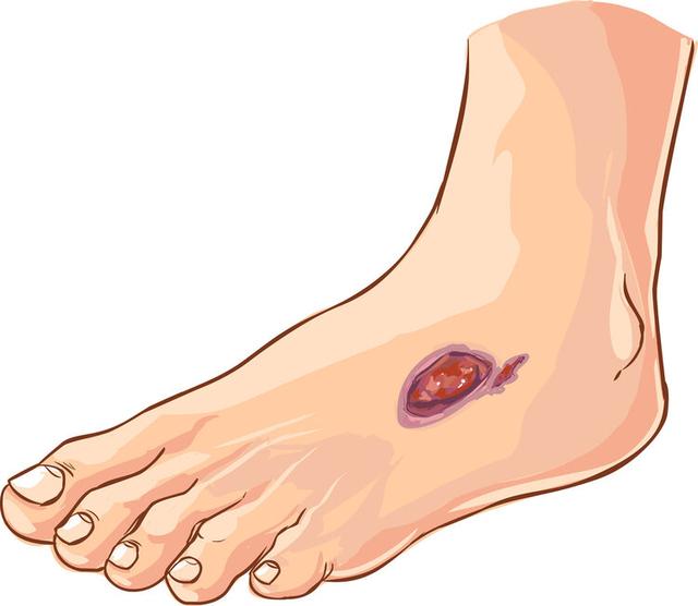 糖尿病血泡(血糖尿泡泡的特点)