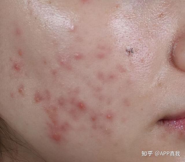 水杨酸可以祛痘吗，水杨酸祛痘可以经常用么（“水杨酸”祛痘效果到底怎么样）