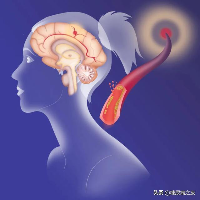 糖尿病并发症的预防(糖尿病并发症的根本原因是什么)