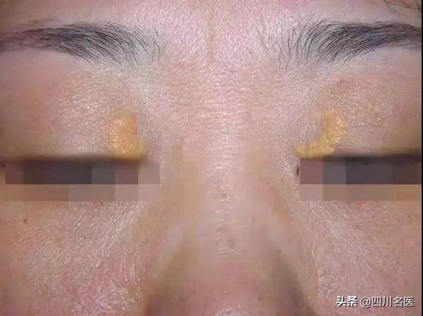 眼肥胖