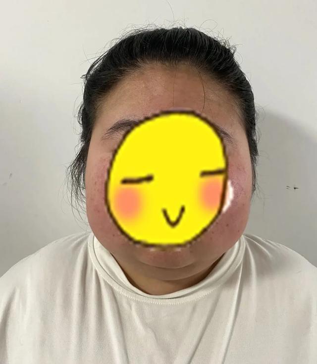 肥胖长了粉刺(肥胖满脸痘痘怎么回事)