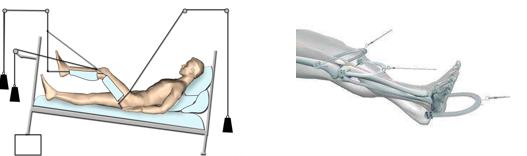 跟骨骨折怎么做牵引，为什么骨折了要做骨牵引