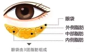 泪沟与眼袋的区别图，卧蚕眼袋和泪沟区别图解（到底“袋”走了什么）