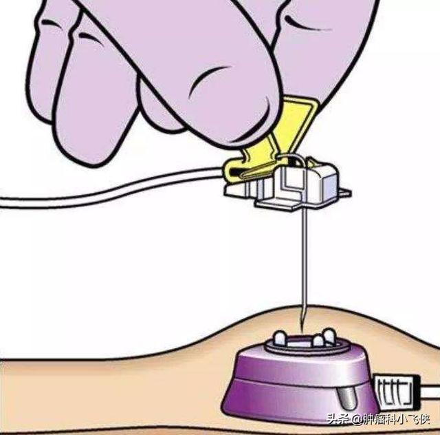 癌症化疗过程是怎样的，化疗究竟是一个什么过程