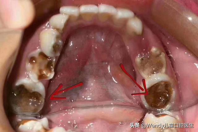 一张刷爆朋友圈的牙片，成年人要做牙齿窝沟封闭