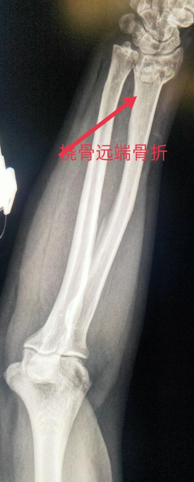 尺桡骨正侧位x线片，学习X线读片指南骨