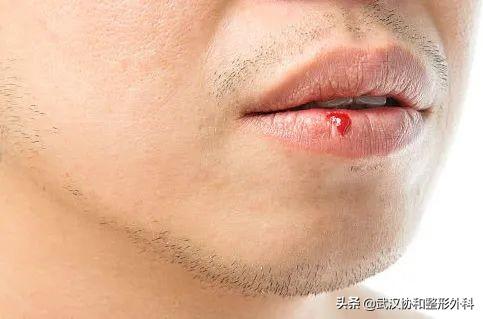 常见的唇部整形都有哪些，唇部整形有什么方法