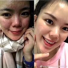 祛痘印最有效的方法无痕，你是如何去祛痘痘印的